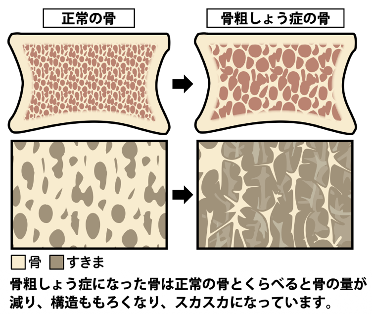 図1 骨の断面図